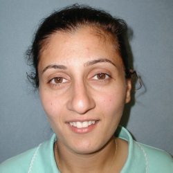 Rhinoplasty Before & After Patient #5532