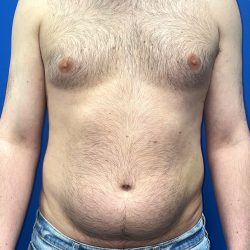 Liposuction Before & After Patient #5511