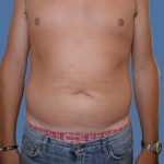 Tummy Tuck Before & After Patient #5565
