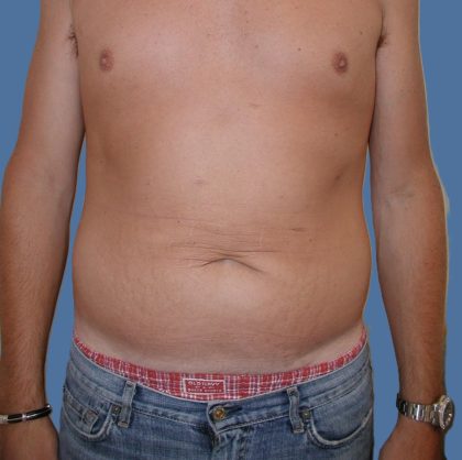 Tummy Tuck Before & After Patient #5565