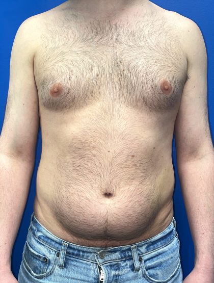 Liposuction Before & After Patient #5511