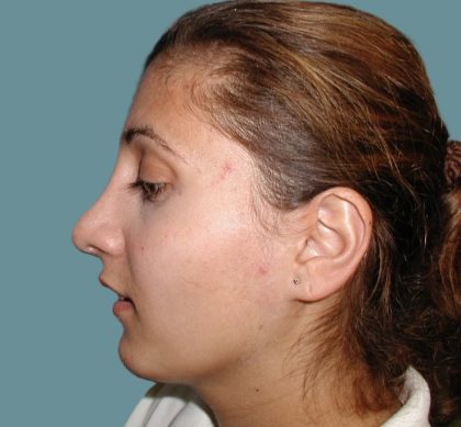 Rhinoplasty Before & After Patient #5532