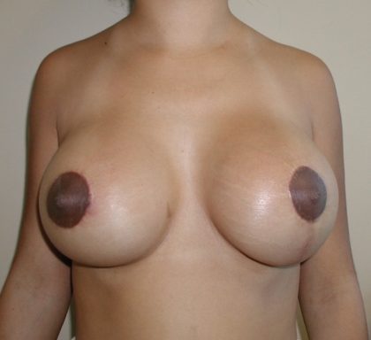 Breast Revision Before & After Patient #5525