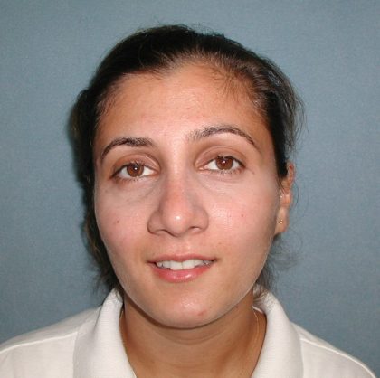 Rhinoplasty Before & After Patient #5532