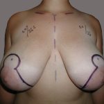 Breast Reduction Before & After Patient #5551