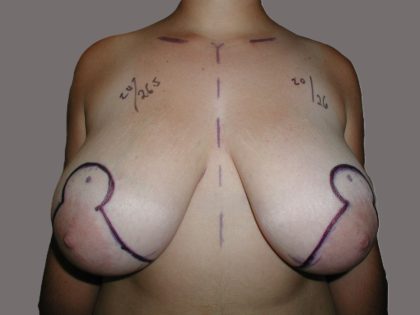 Breast Reduction Before & After Patient #5551