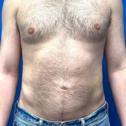 Liposuction Before & After Patient #5511