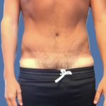 Tummy Tuck Before & After Patient #5565