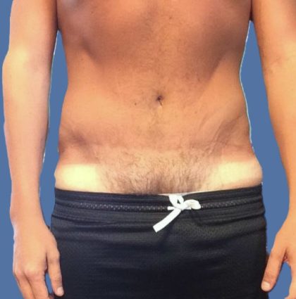 Tummy Tuck Before & After Patient #5565