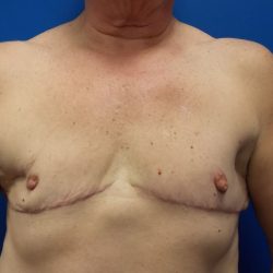 Female-to-Male Before & After Patient #5568