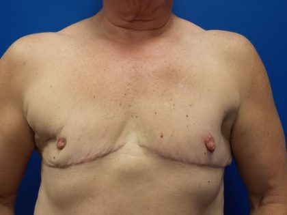 Female-to-Male Before & After Patient #5568
