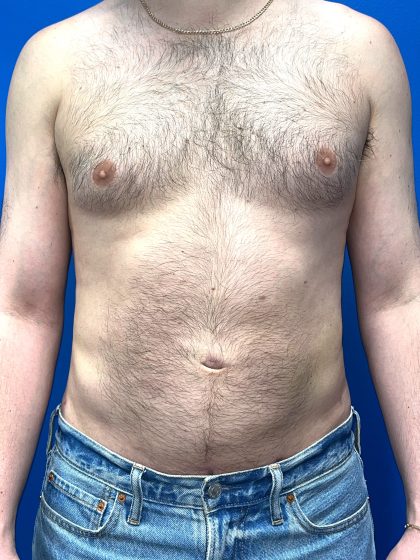 Liposuction Before & After Patient #5511