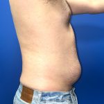 Liposuction Before & After Patient #5511