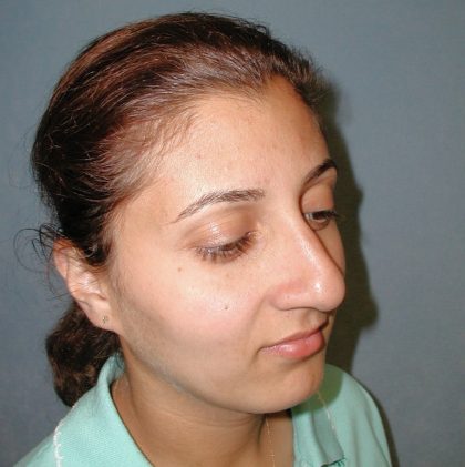 Rhinoplasty Before & After Patient #5532