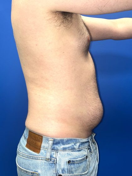 Liposuction Before & After Patient #5511