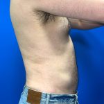 Liposuction Before & After Patient #5511