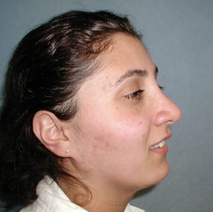 Rhinoplasty Before & After Patient #5532