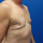 Female-to-Male Before & After Patient #5568