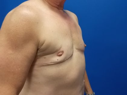 Female-to-Male Before & After Patient #5568