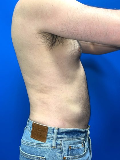 Liposuction Before & After Patient #5511