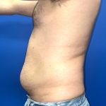Liposuction Before & After Patient #5511