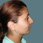 Rhinoplasty Before & After Patient #5532