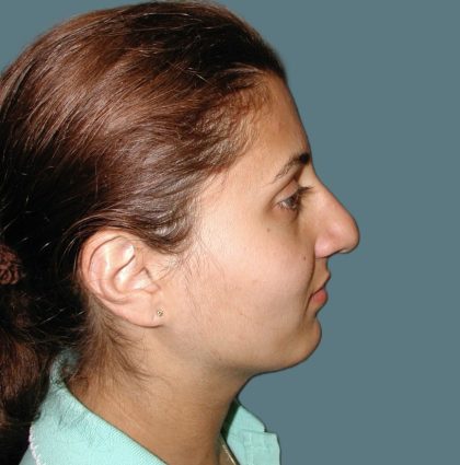 Rhinoplasty Before & After Patient #5532