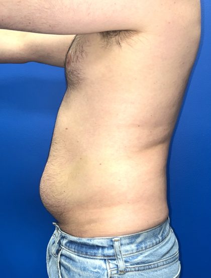 Liposuction Before & After Patient #5511