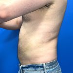 Liposuction Before & After Patient #5511