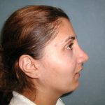 Rhinoplasty Before & After Patient #5532