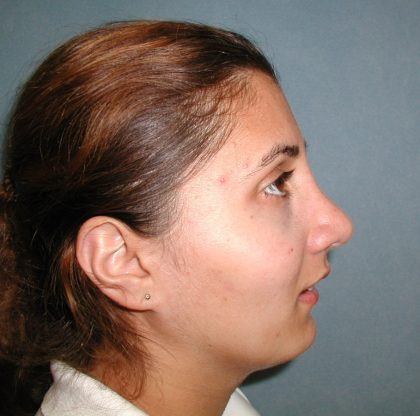 Rhinoplasty Before & After Patient #5532
