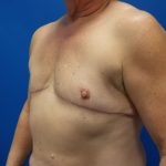 Female-to-Male Before & After Patient #5568