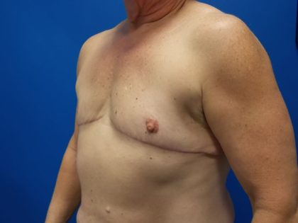 Female-to-Male Before & After Patient #5568