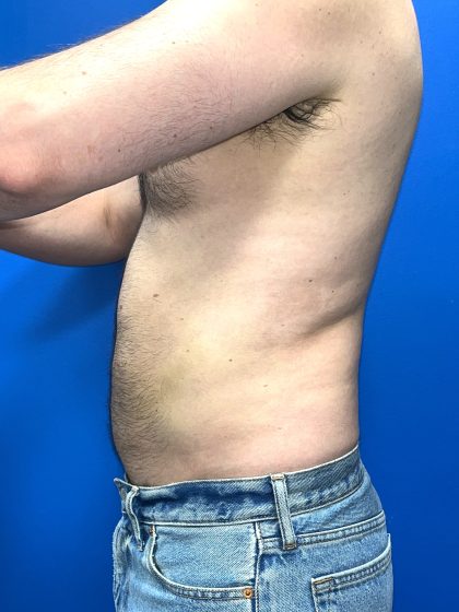 Liposuction Before & After Patient #5511