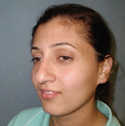 Rhinoplasty Before & After Patient #5532
