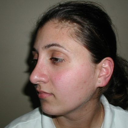 Rhinoplasty Before & After Patient #5532