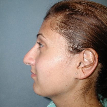 Rhinoplasty Before & After Patient #5532