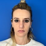 Rhinoplasty Before & After Patient #5612