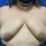 Tissue Expander To Implant Breast Reconstruction Before & After Patient #5638