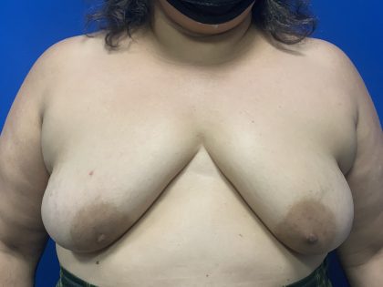 Tissue Expander To Implant Breast Reconstruction Before & After Patient #5638