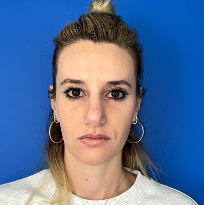 Rhinoplasty Before & After Patient #5612