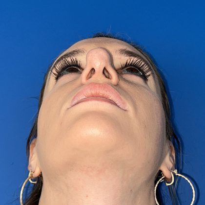 Rhinoplasty Before & After Patient #5612