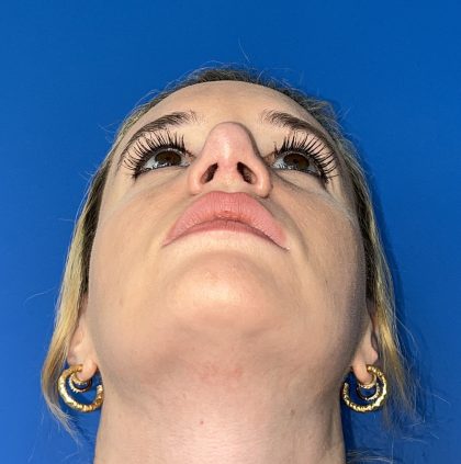 Rhinoplasty Before & After Patient #5612
