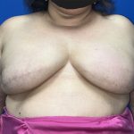 Tissue Expander To Implant Breast Reconstruction Before & After Patient #5638