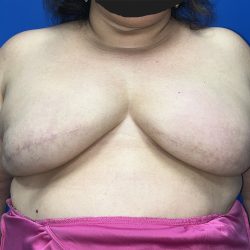 Tissue Expander To Implant Breast Reconstruction Before & After Patient #5638