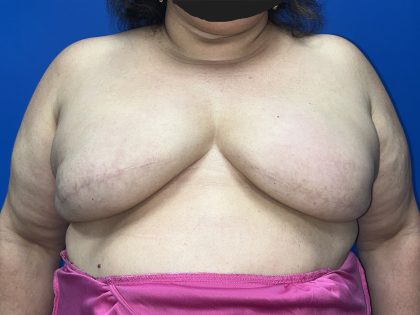 Tissue Expander To Implant Breast Reconstruction Before & After Patient #5638