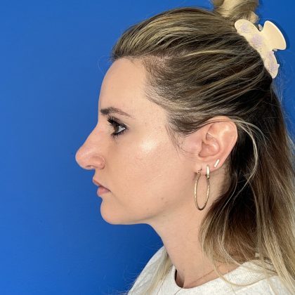Rhinoplasty Before & After Patient #5612