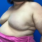 Tissue Expander To Implant Breast Reconstruction Before & After Patient #5638