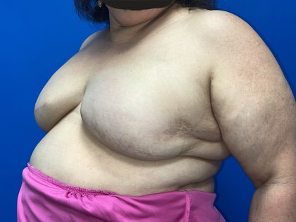 Tissue Expander To Implant Breast Reconstruction Before & After Patient #5638