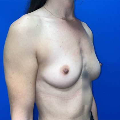 Breast Augmentation Before & After Patient #5630